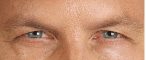botox2